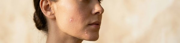 Acne
